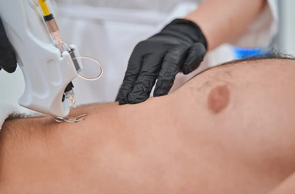 Mesotherapie 5 Mesotherapie bild 3